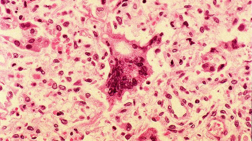 Vírus do sarampo. Foto: Wikipedia